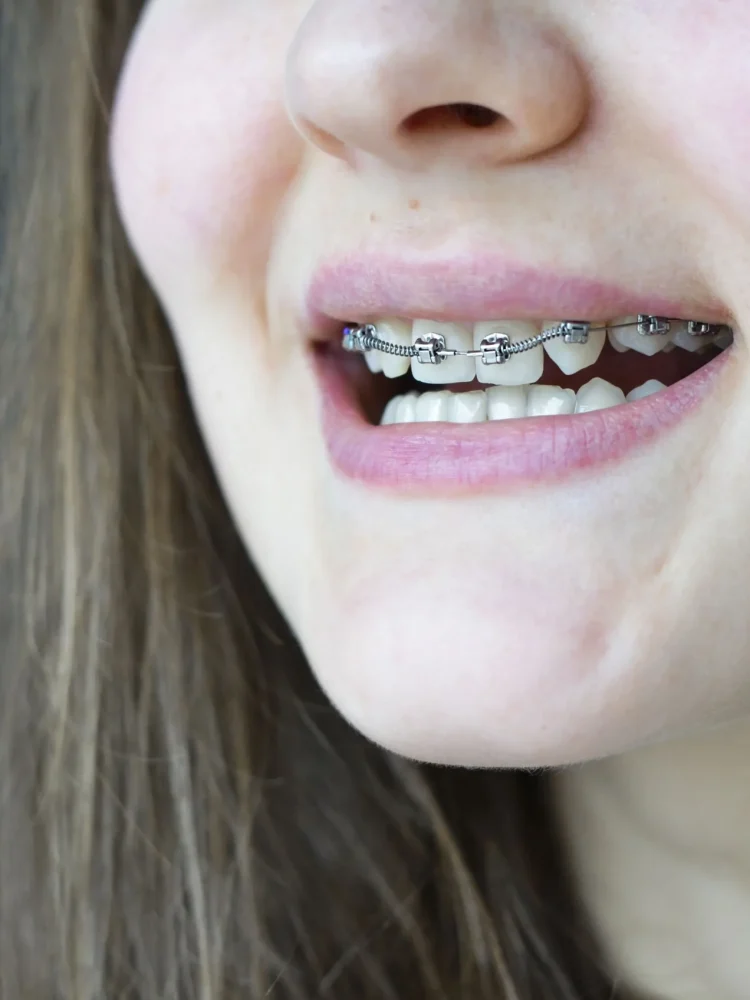 brackets metálicos